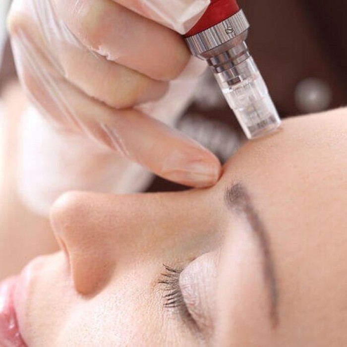Nano Mesotherapy Treatment For 10 Session
